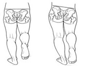 Gluteal Tendinopathy